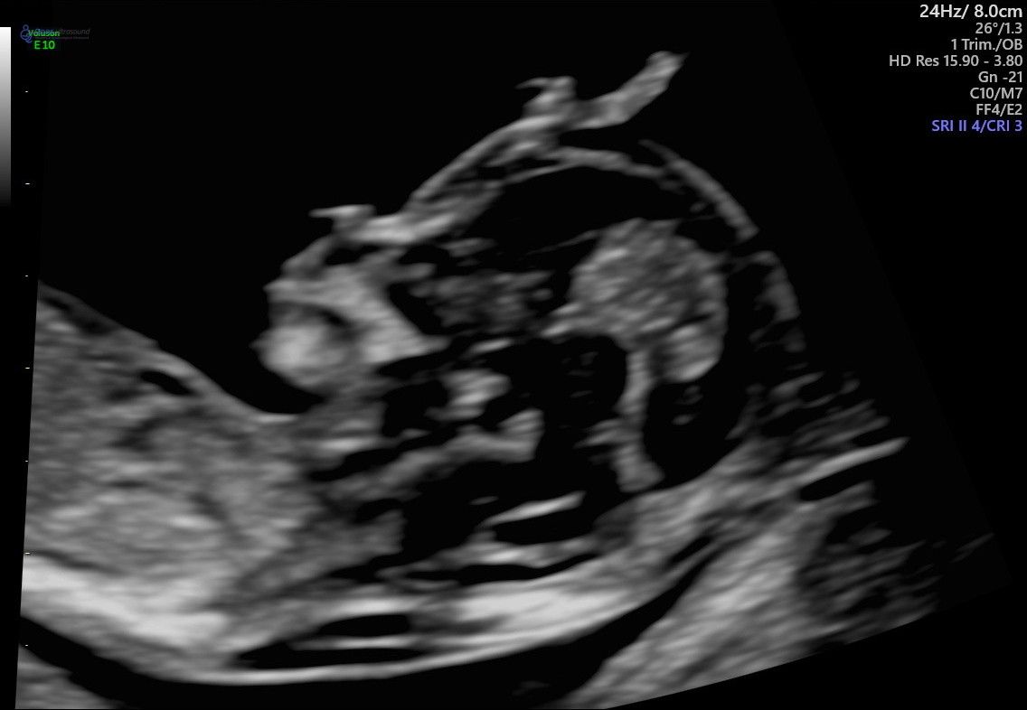 12 Week Scan