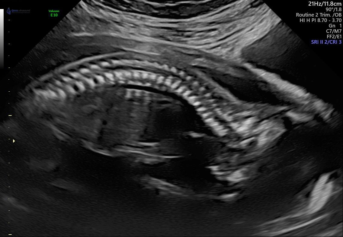 20 Week Scan