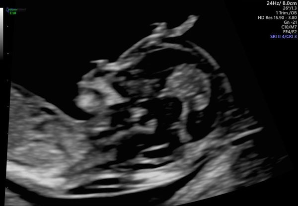 12 Week Scan