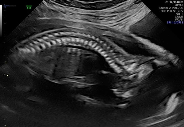 20 Week Scan